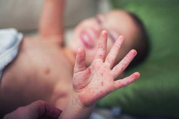 Hand, Foot, and Mouth Disease